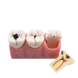 Modelo Desmontable Caries Bader