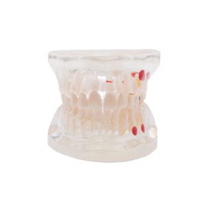 Modelo transparente de caries Bader
