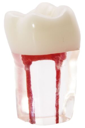 Molar con Conductos Radiculares Bader